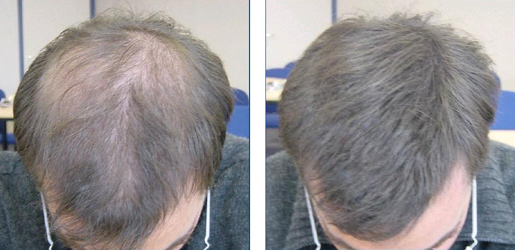 Типы и причины выпадения волос на голове мужчины